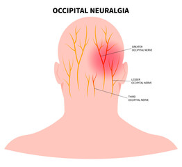Headache with the occipital neuralgia nerve pain that cause migraine - obrazy, fototapety, plakaty
