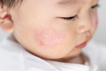 頬が肌荒れしている赤ちゃん（男の子、0歳、生後11カ月、日本人） - obrazy, fototapety, plakaty