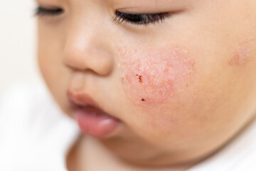 頬が肌荒れしている赤ちゃん（男の子、0歳、生後11カ月、日本人）