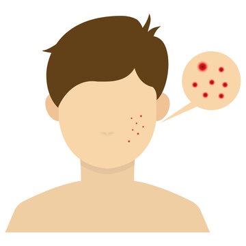 Vector illustration of pimple on cheek icon sign and symbol. colored man icons for website design .Simple design on transparent background (PNG).