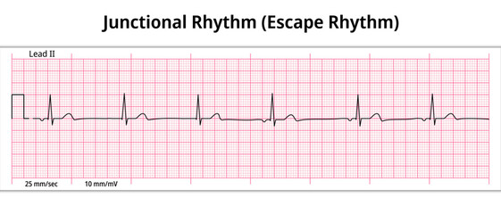 ECG Junctional Rhythm - Escape Rhythm - 8 Second ECG Paper - Electrocardiogram Vector Medical Illustration