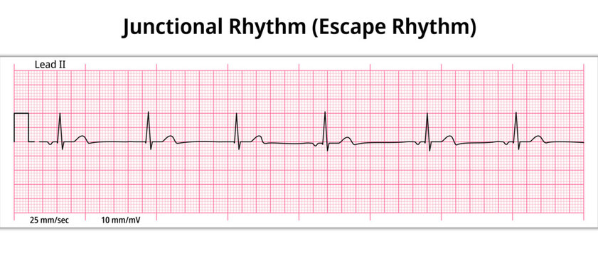 ECG Junctional Rhythm - Escape Rhythm - 8 Second ECG Paper - Electrocardiogram Vector Medical Illustration