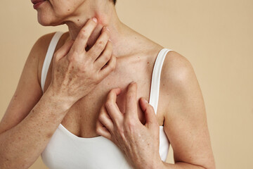 Close up of adult woman scratching neck suffering from itch and allergies, copy space