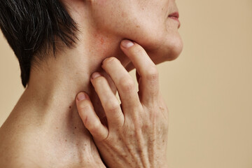Closeup of adult woman with short hair scratching neck suffering from anxiety or skin condition, copy space - obrazy, fototapety, plakaty