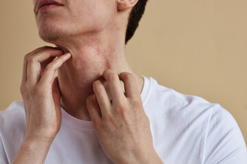 Close up of young man scratching neck suffering from itch and allergies, copy space