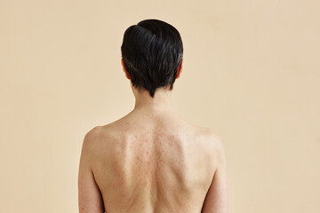Naklejka premium Minimal rear view of adult woman with rash spots on bare back standing against beige background, copy space