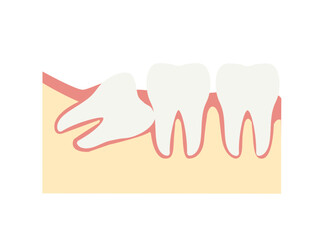 親知らずの図解イラスト