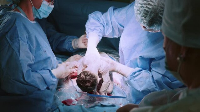 Maternity hospital. Baby being born by caesarean section. Group of doctors in mask bent their heads over the patient. Medics perform C-section operation. Doctor and nurse are pulling a new born baby