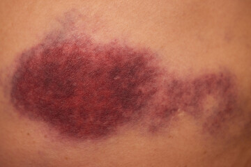 Accidents and wounds caused by impact. Purple skin bruises and abrasions.