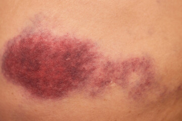 Accidents and wounds caused by impact. Purple skin bruises and abrasions. - obrazy, fototapety, plakaty