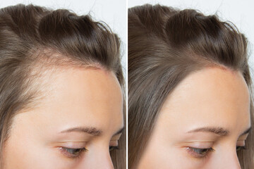 Cropped before and after head shot of a young woman with bald patches on her forehead and temples....