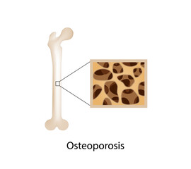 Osteoporosis, bone disease. Close-up of bone marrow density (BMD). Aging process. Medical concept. Vector illustration.