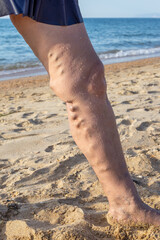 Woman's leg with varicose veins against the background of the sea. Spa treatment for sore legs