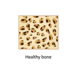 Healthy bone. Close-up of bone marrow density (BMD). Aging process. Osteoporosis, bone disease. Medical concept. Vector illustration.