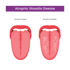 Comparison of normal human tongue and atrophic glossitis disease