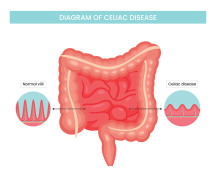 Structural diagram of celiac disease