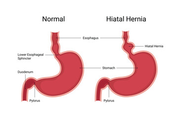 Normal human stomach compared to hiatal hernia
