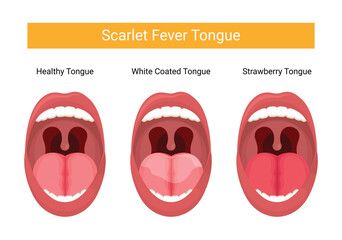 Illustration of dengue fever tongue stage - obrazy, fototapety, plakaty