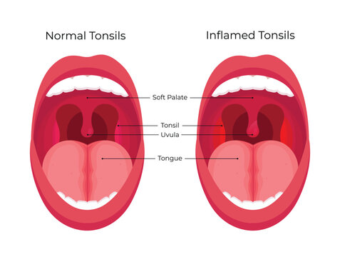 Comparison of normal human tonsils and inflamed tonsils