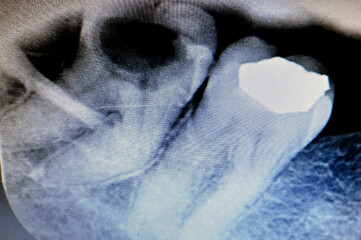 X ray on wisdom 8th lower right tooth with a teeth decay, after exposed nerve and severe pain,...
