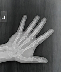 Film xray or radiograph of a normal left hand of an adult male. AP view show human's hand. normal bone structure of all phalanges carpal bones metacarpal, distal radius and ulna. joint space is normal - obrazy, fototapety, plakaty