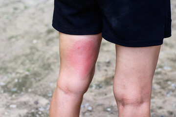 Asian woman left leg back with red rash swelling from bee sting on skin allergy background