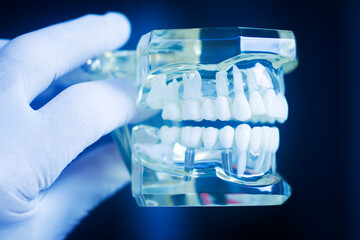 Dental tooth implant model