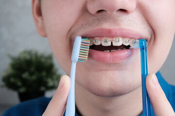 Teenager young man, European, close-up of braces on his teeth. Holds a toothbrush. Concept special...