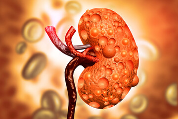 Chronic kidney disease, kidney cancer. 3d illustration