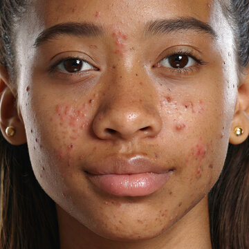 Children with acne problems on the face