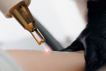Closeup laser tattoo removal from woman hand in salon