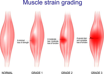 Muscle strain grading