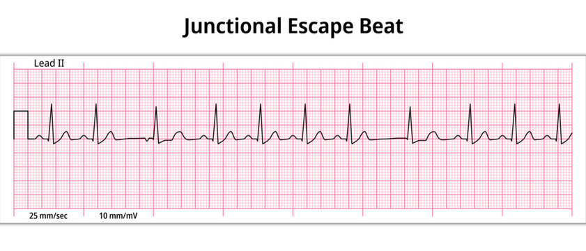 ECG Junctional Escape Beat - 8 Second ECG Paper - Electrocardiogram Vector Medical Illustration