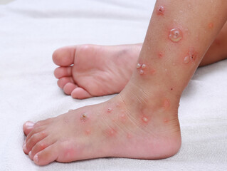 foot child asian Infection blister chicken pox dermatology measles medical allergic skin disease reaction red stickers  virus hfmd