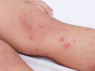 disease hand foot mouth in people asian kid blister infection  irritated hfmd rash skin