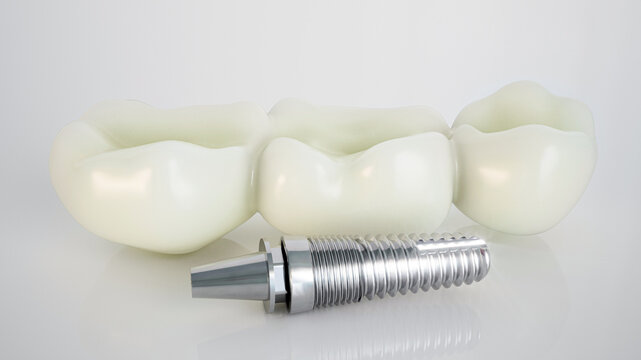 Dental Implant: Modern Solution for Tooth Replacement - 3D Rendering