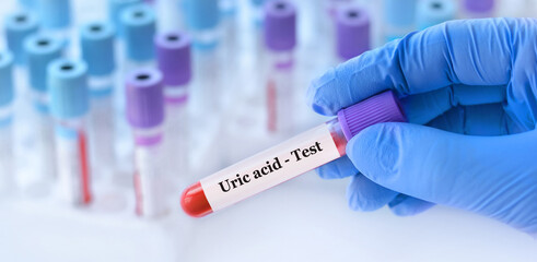 Doctor holding a test blood sample tube with uric acid test on the background of medical test tubes...
