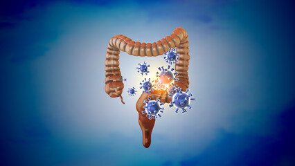 Medical concept of a large intestinal infection	
