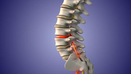 Sciatic nerve pain due to herniated disc	
 - obrazy, fototapety, plakaty