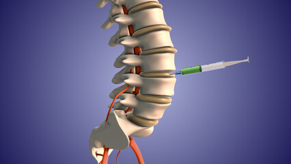 Injecting steroids to treat herniated disc pain	
