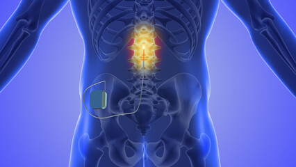 Spinal cord stimulation medical concept	 - obrazy, fototapety, plakaty