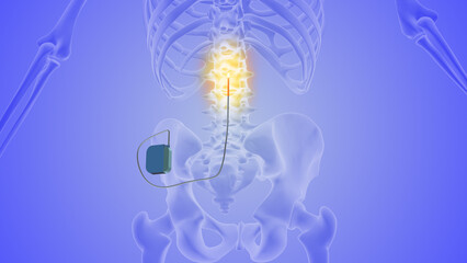 The medical notion of spinal cord stimulation	
