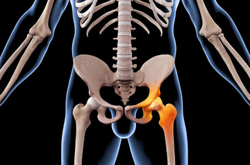Skeleton with osteoarthritis hip joint injury - obrazy, fototapety, plakaty