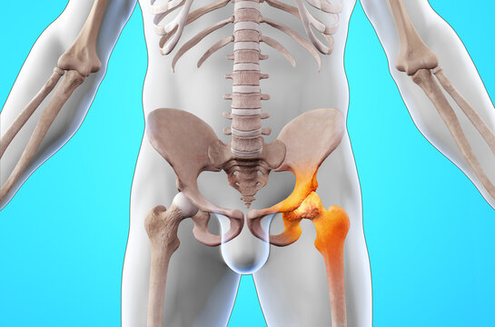 Skeleton with osteoarthritis hip joint injury