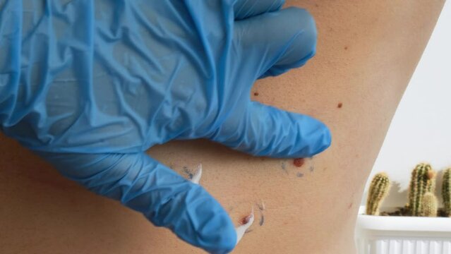 Dermatologist apply skin cream on male birthmarks. Checking benign moles. Presentation of skin cancer procedure. Doctor checking skin tags on man