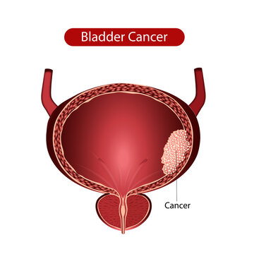 bladder illustration, bladder cancer, cancer cells,  cancer anatomy adenocarcinomas, adipose tissue, anatomical, anatomy, 