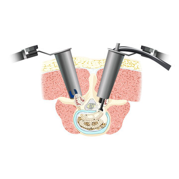 Transforaminal Lumbar Interbody Fusion (TLIF)