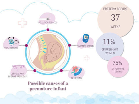 Possible causes of premature pregnancy.
Circular diagram with the 5 main causes, tobacco, hypertension, uterine problems, infections, diabetes, blue and pink tones on white background.