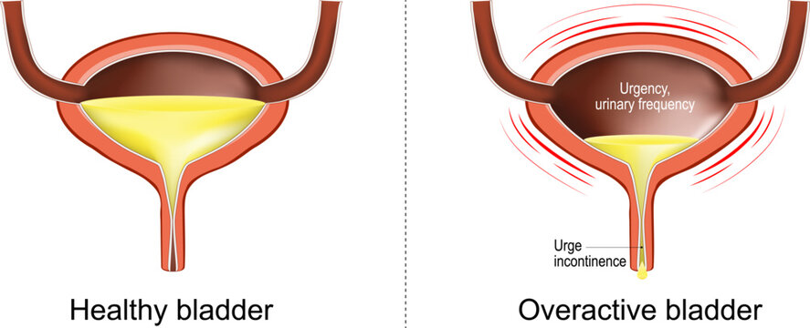Overactive bladder. Loss of bladder control.