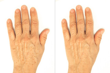 Age spots on the hands before and after removal using a lightening whitening cream. Rejuvenation...